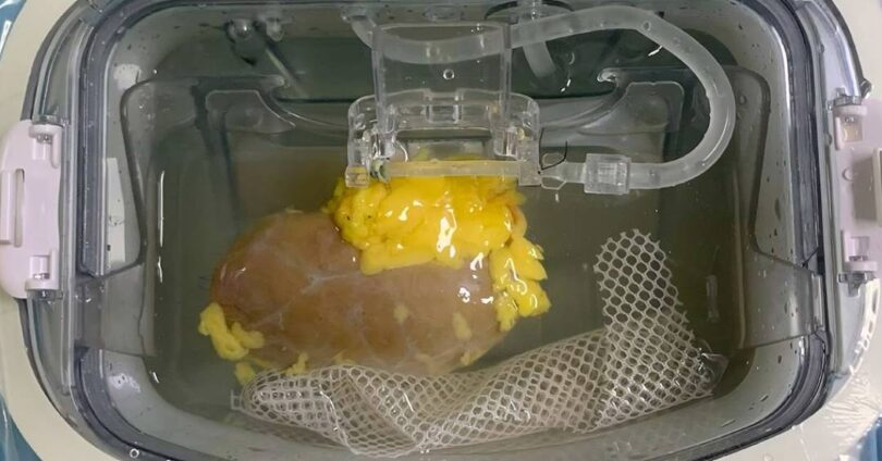 Médicos Realizam Inovador Transplante De Rim Com Tipo Sanguíneo Modificado 1 2025 word3