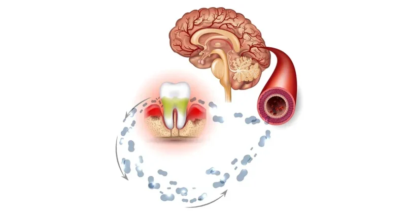 Microbioma Oral: Influência No Risco De Demência 1 2025 word1