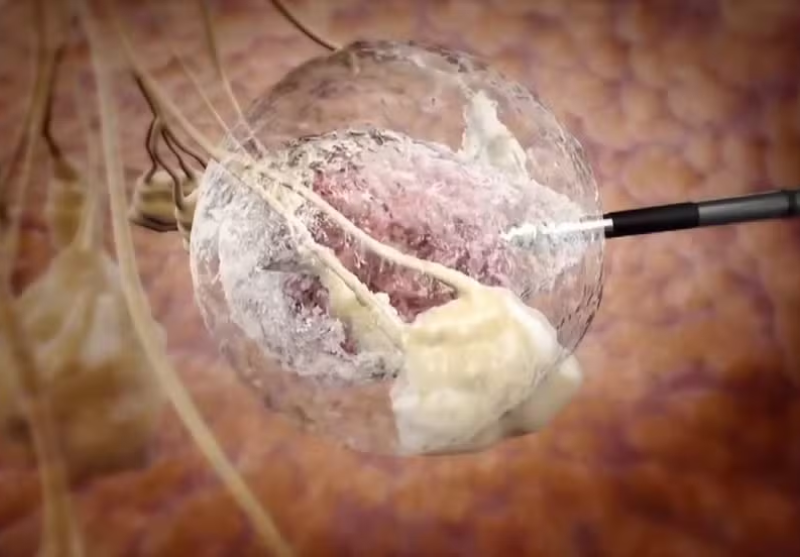 Brasil Inova Com Técnica De Combate Ao Câncer De Mama: Congelamento No Tratamento 1 2025 word2