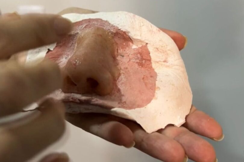 Próteses Faciais Gratuitas Para Pacientes Com Câncer De Pele Em Mt: Uma Ajuda Essencial 1 2025 word3