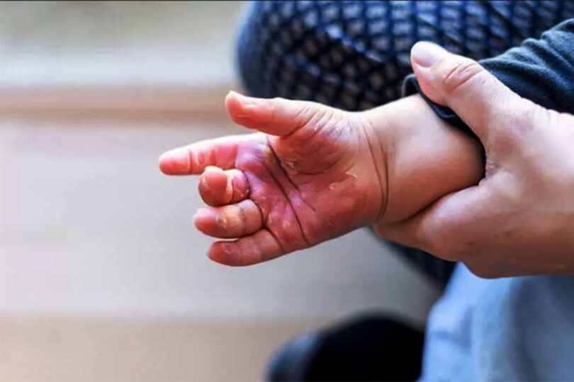 Queimaduras Em Crianças: Mt Registra 51 Casos, Especialistas Alertam Sobre Cuidados Durante As Férias 1 2025 word1