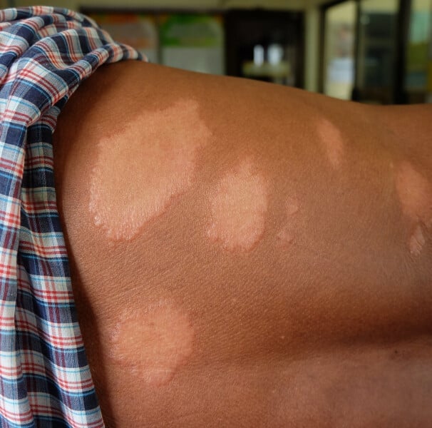 Cuiabá Combate Estigma Da Hanseníase Com Janeiro Roxo: 1 1 2026 word2