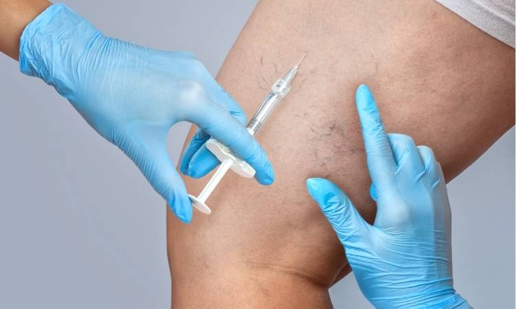 Procedimento Médico Para Tirar Varizes. Tratamento de varizes.