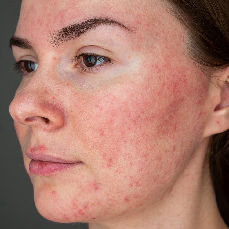 Rosacea-Doenca-De-Pele-2 Mulher com rosácea
