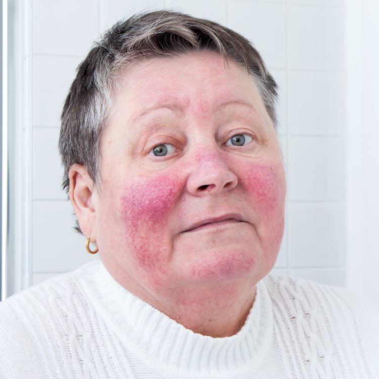 Rosacea-Doenca-De-Pele-5 Mulher idosa com rosácea. Ela veste blusa de lã branca e usa brincos de argola pequeno dourado. Seu cabelo é curto e tem olhos claros