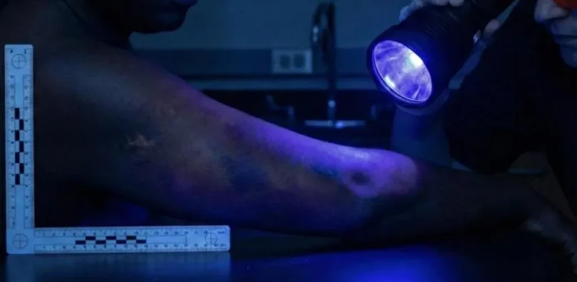 Estudo: Uso De Luzes Forenses Na Identificação De Hematomas 1 2026 word3