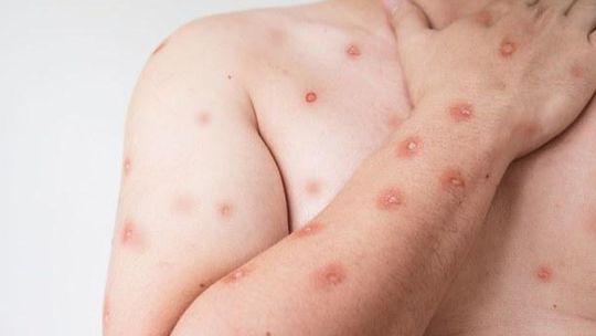 Ses Alerta Para Monitoramento De Casos De Meningite Em Mato Grosso Devido A Variante Em Rondônia 1 2026 word2