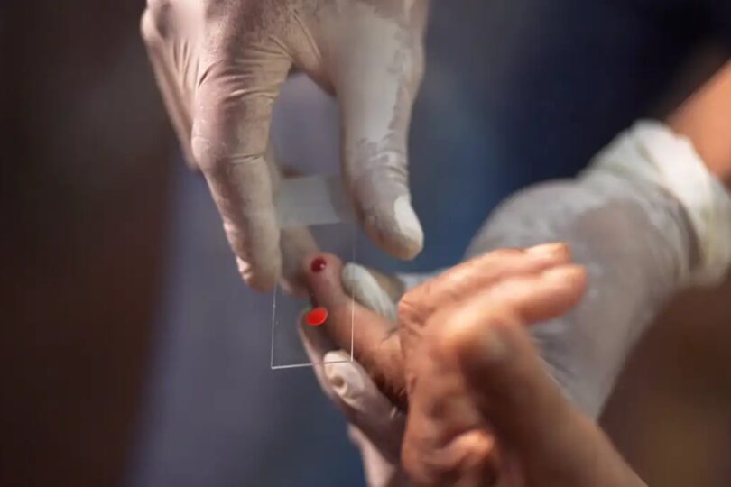 Sus Passa A Disponibilizar Tratamento Inovador Contra Malária Infantil No Brasil 1 2026 word3